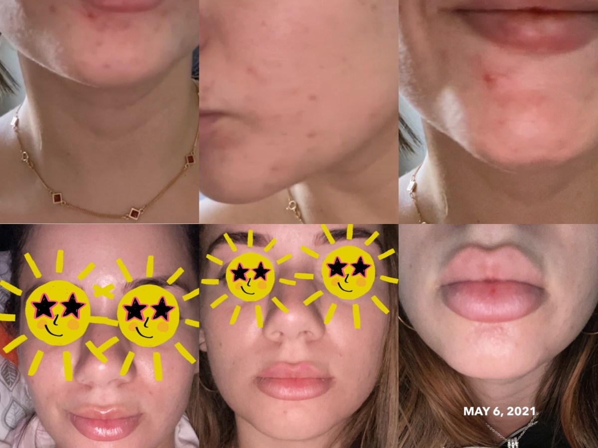 How To Get Rid Of Face&nbsp;Acne!